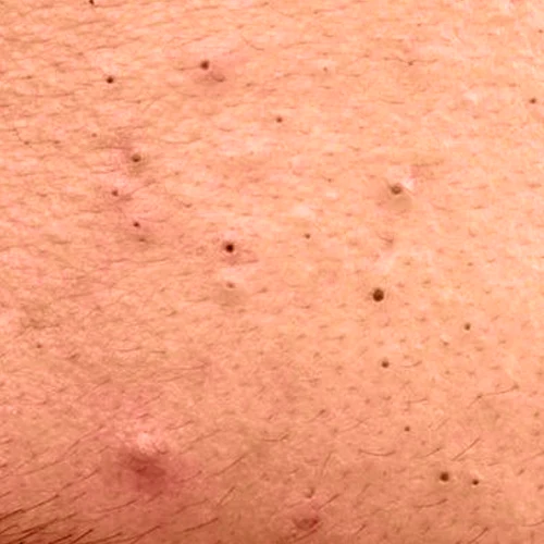 روتین پوستی ضد جوش و آکنه 2 skin1