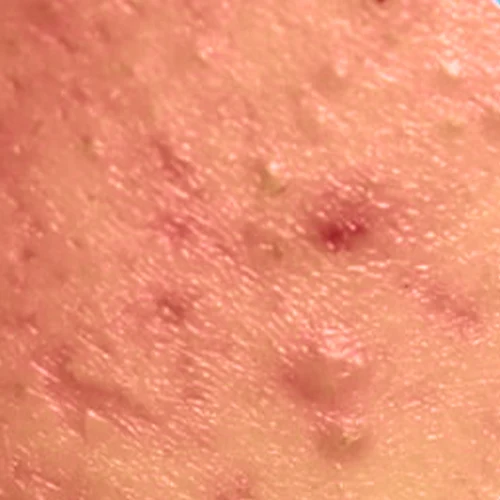 روتین پوستی ضد جوش و آکنه 3 skin2