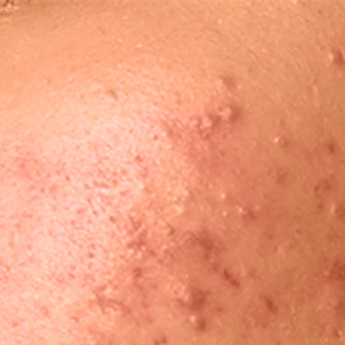 روتین پوستی ضد جوش و آکنه 4 skin3