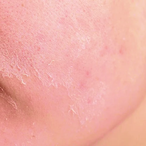 روتین پوست خشک و کم آب 4 skin3