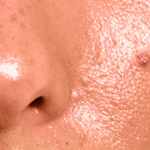 روتین پوست چرب و دارای منافذ 2 skin1