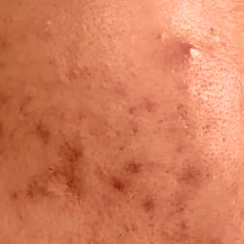 روتین پوست چرب و دارای منافذ 3 skin2