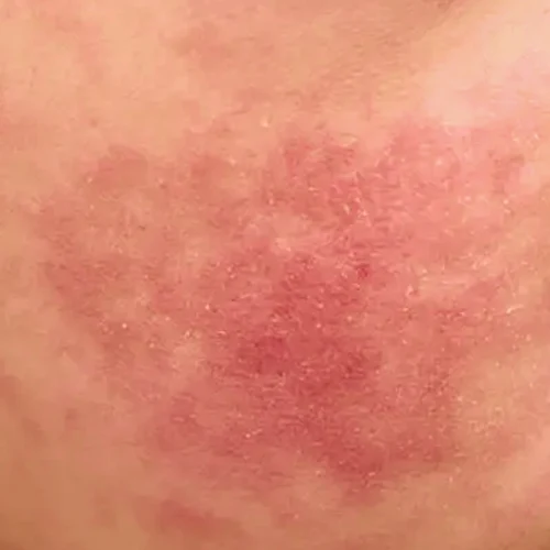 skin2