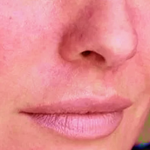 skin3